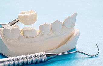 Mold of mouth, ceramic crown, and dental instruments on blue background