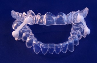 An oral appliance for obstructive sleep apnea (OSA)