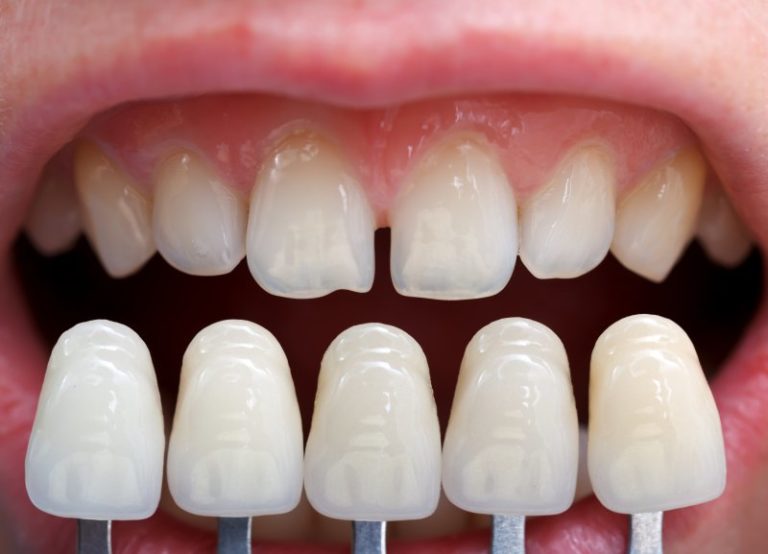 Dental Crowns and Porcelain Veneers How You Can Fix